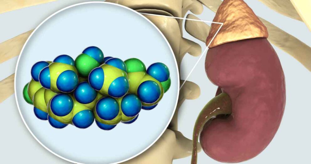 adrenal pcos